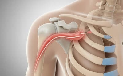 Quiropraxia e Síndrome do Impacto Subacromial: Tratamento Eficaz para Dor no Ombro